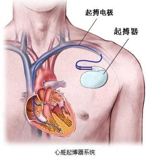 当代社畜的心脏起搏器(工作起搏器机器人青年职场) 99链接平台